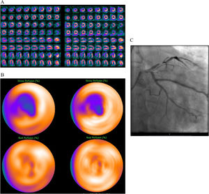 50 year old male, BMI 29, hypertension, hyperlipidaemia and typical angina. Referred to MPI to rule out ischemia. MPI evaluation without DLACS (left images). Splash (A) and bulls-eye MPI (B) stress (upper row) and rest (lower row) in the upright position showing a perfusion defect in the anterior wall with reversibility at rest. Significant obstruction of the left anterior descending artery confirmed at ICA (C). MPI evaluation using DLACS (right images) showing a perfusion defect in the anterior wall with reversibility at rest. True positive case both with and without DLACS, confirmed at ICA.