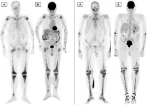 The bone scintigraphy findings (A) and in the maximum intensity projection (MIP) image of the 2-[18F]FDG-PET (B) in two different patients showing a similar distribution of the radiopharmaceutical at the appendicular skeletal level. The involvement of the diaphyseal-metaphyseal regions in the proximity of the knees, as shown in these two cases, is a practically pathognomonic image in patients with ECD.