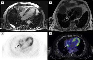 Cardiac involvement in the form of a myocardial mass in the right atrium. A: cardiac MR images identifying involvement of the right atrium. B: PET/CT images showing physiological activity in the left ventricle and an increase in glycidic metabolism in the right atrium in accordance with the existing cardiac involvement.
