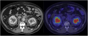 CT images with contrast and 2-[18F]FDG-PET/CT showing renal/pararenal involvement, with visualization of the hairy kidney sign. This sign refers to the ring of soft tissue of perinephric infiltration observed in the axial imaging studies in ECD and is considered pathognomonic of this disease. The description of “hairy” refers to the associated thickening of the perinephric septa (Kunin septa), which are bands of fibrous tissue that extend between the renal capsule and the perinephric fascia. The metabolic activity in these alterations is variable and even scarce, such as in the case shown here.