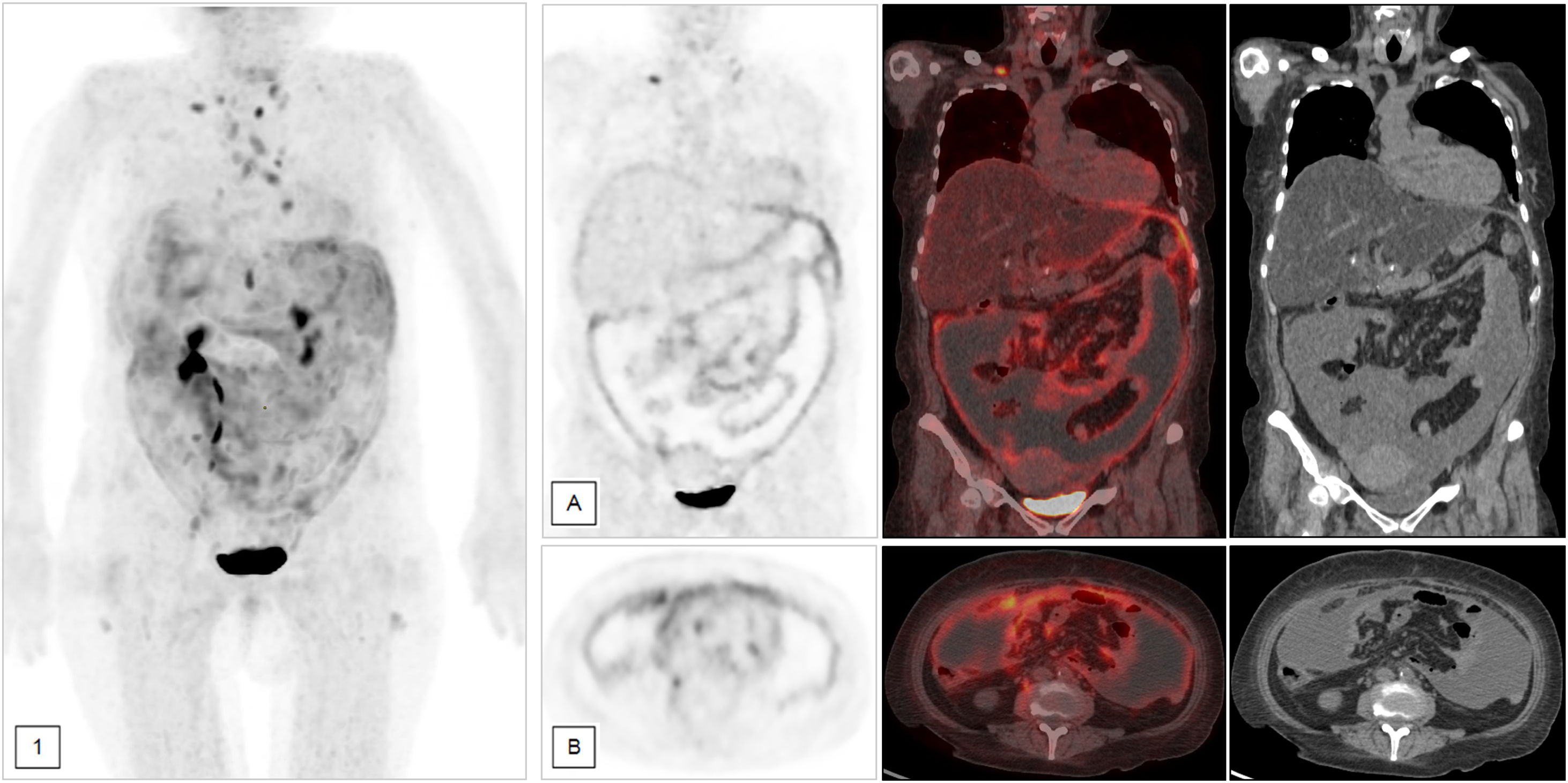Role of [18F]F-FDG PET/CT in the detection and differential diagnosis ...