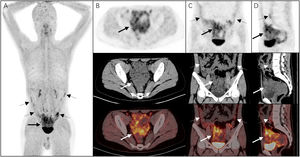 The MIP (A) image of 68Ga-FAPI PET/CT revealed increased FAPI uptake in the pelvic cavity (solid arrow) and lower abdomen (dotted arrows). On the axial (B), coronal (C), and sagittal (D) images of PET/CT images showed the irregular soft tissue masses with intense uptake (SUVmax, 7.9) in the pelvic cavity (solid arrows). Diffuse thickening of the peritoneum (dotted arrows) with increased tracer uptake (SUVmax, 6.8) was also observed (upper row: PET; middle row: CT; lower row: fused PET/CT).