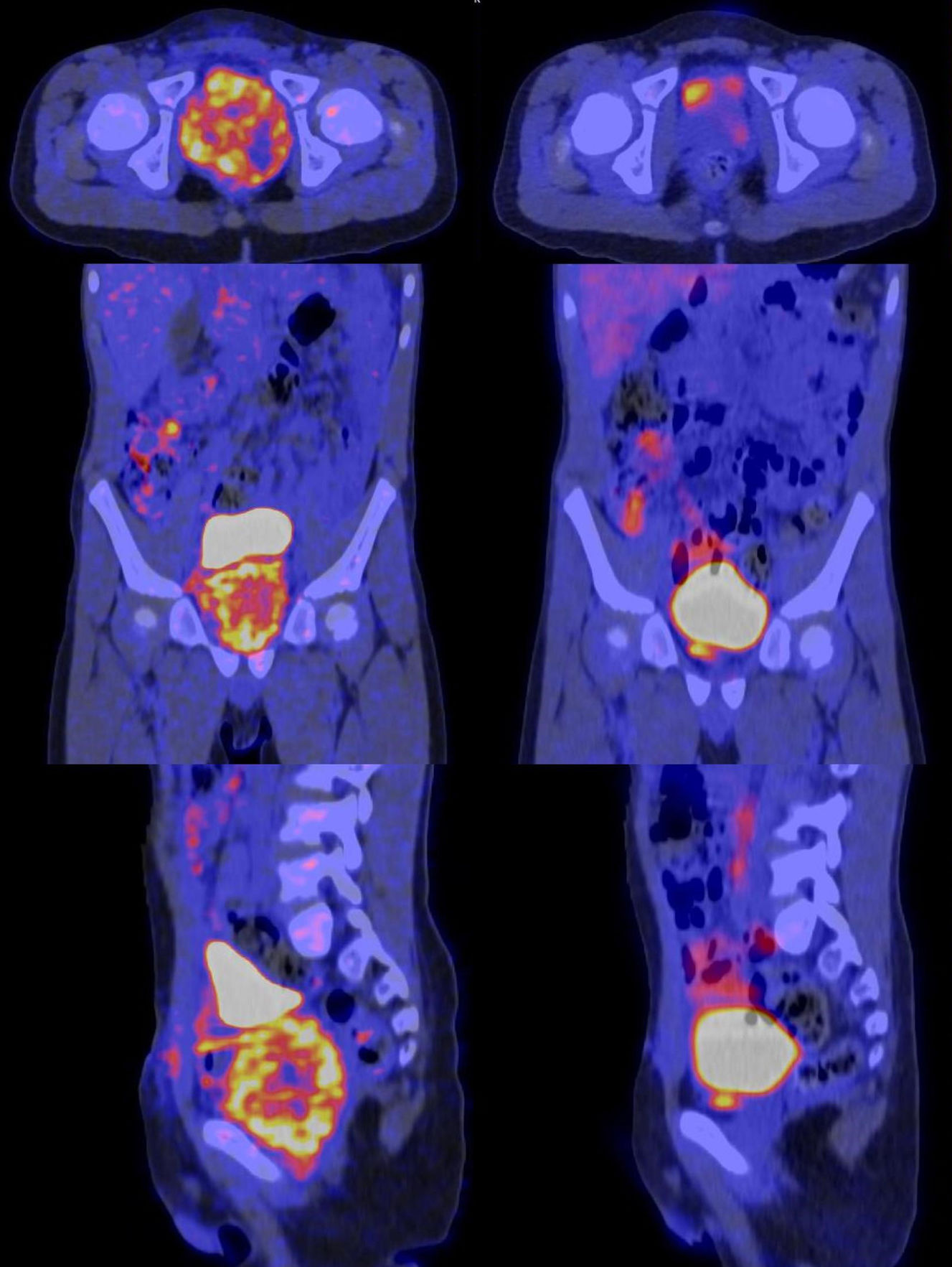 Prostatic rhabdomyosarcoma in a 6 years old patient evaluated by [18F ...