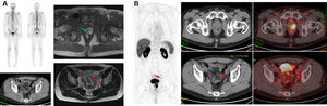 Staging of high-risk PCa with PET-PSMA. A 59-year-old patient with PC, Gleason 9 (5 + 4). (A) Shows composite image with Bone Scan, CT and MRI for staging with T3N0M0 result. (B) Shows unsuspected lymph node involvement and changes the stage to N1.