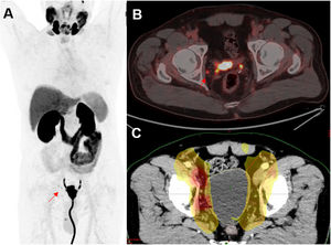 Lymph node recurrence with positive response to radiotherapy. Lymph node recurrence with positive response to radiotherapy. 57-year-old patient with PC, Gleason 7, RP R0. BR with PSA 0.26 ng/mL with PSA doubling time: 10 months (CT, bone scan, MRI and PET-CT [18F]fluorocholine negative). PET-PSMA shows right obturator adenopathy (red arrow). (A) MIP image and (B) Axial fusion slice. (C) Change in RT planning, overprint adds irradiation volumes on the right side to the standard RT planning.