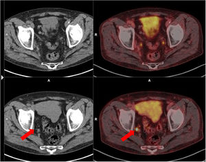 Lymph node recurrence rescued with surgery. Lymph node recurrence rescued with surgery. A 70-year-old patient with a history of Gleason 8 (4 + 4) PC treated with RP. Two years after surgery, PSA level was elevated (0.2 ng/mL), so PET-PSMA was performed, which showed lymph node recurrence in a 3 mm right internal iliac adenopathy (bottom row). The lesion was rescued with surgery. A follow-up PET/CT (top row) confirmed complete excision of the lesion.