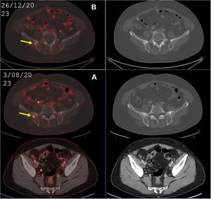 PET-PSMA detection of oligometastases. A 53-year-old patient with Gleason 9 (5 + 4) PC, 100% cylinders. Negative CT and bone scan (cT4N1M0.). (A) Axial images of PET/CT with [18F]DCFPyL detect lymph node involvement in the right external iliac and a single bone metastasis in the right iliac bone with no findings on CT. (B) Follow-up PET/CT with [18F]DCFPyL confirms a metastatic bone lesion with sclerotic changes on CT.