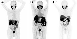 MIP images of the three PSMA radiopharmaceuticals. PET/CT with: (A) [18F]DCFPyL. (B) [68Ga]Ga-PSMA-11. (C) [18F]F-PSMA-1007.