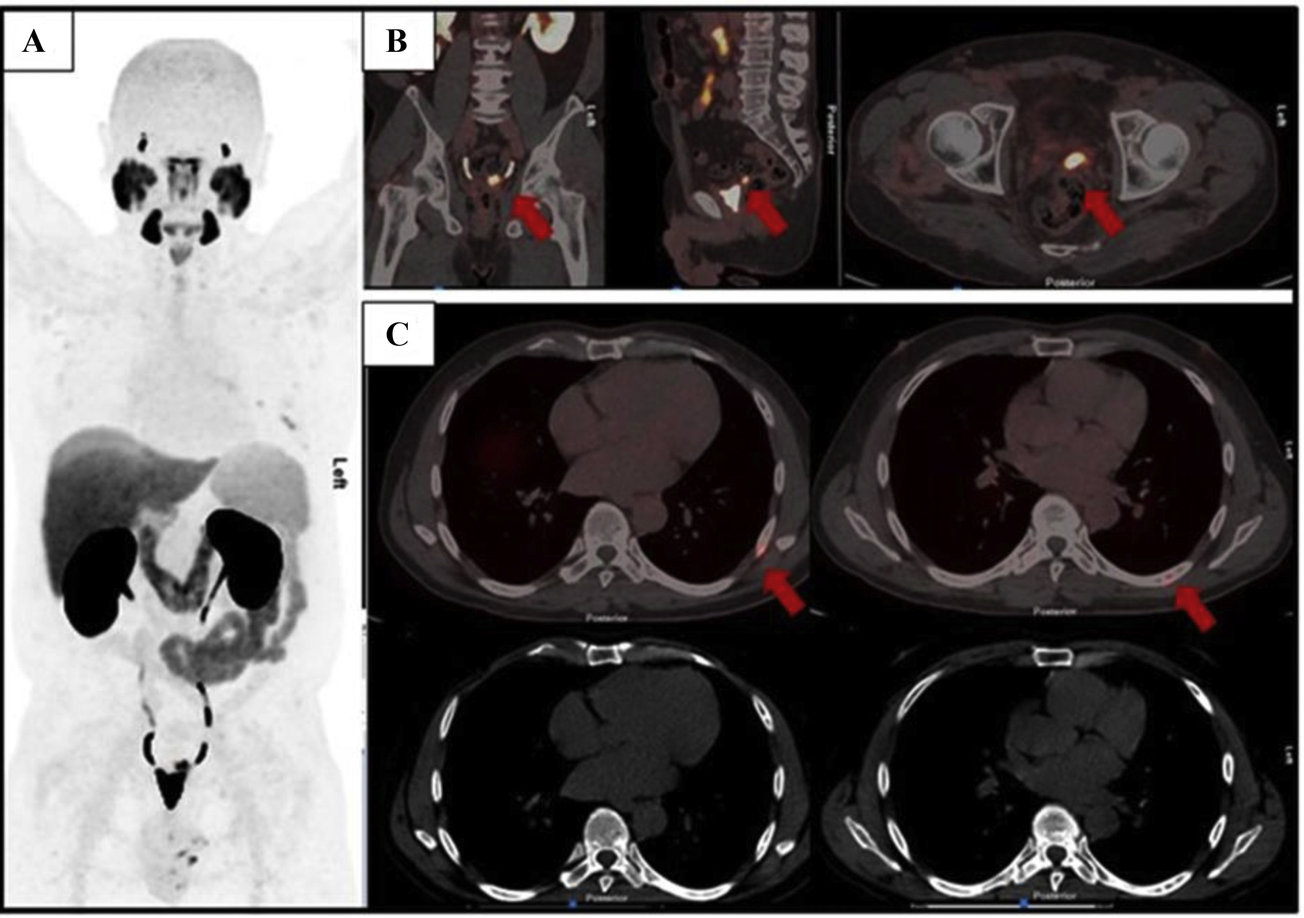 Interobserver and intraobserver agreement in PET/CT with [18F]DCFPyL ...
