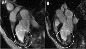 (A) and 3 chamber (B) end-diastole image of late Gadolinium enhancement sequence. Hypertrophy is observed at the lower apical level and strict apex with the presence of late enhancement of transmural distribution in both segments. Very likely lamellar thrombus. In the cine sequences (not attached due to their video format) a non-dilated left ventricle is evident with LVEF at the normal low limit value (LVEF 54%).