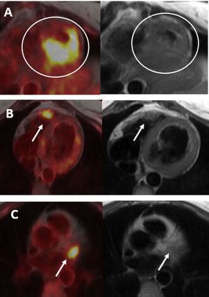 Axial PET/MR fusion images and axial CMR black blood sequences. Hyperuptake of [18F]F-FDG in lower mid-apical segments and apex of LV which is thickened on CMR (A), with active focus on the anterior wall of the right ventricle, with slight thickening on CMR (B) and hyperuptake of the tracer in the left appendage, without practical translation in CMR (C). Axial PET/MR fusion images and axial CMR black blood sequences. Hyperuptake of [18F]F-FDG in lower mid-apical segments and apex of LV wich is thickened on CMR (A), with active focus on the anterior wall of the right ventricle, with slight thickening on CMR (B) and hyperuptake of the tracer in the left appendage, without practical translation in CMR (C).