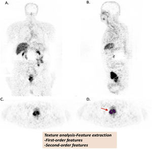 Texture analysis of [68Ga]Ga-PSMA images (A. Coronal, B. Sagittal, C. Axial, D. Axial images with VOİ (red arrow)). Patient images were uploaded in DİCOM format (A-B-C-D). Volume of interests (VOİ) of primary prostate tumors were drawn semi-automatically. Primary tumor lesions were segmented by using 40% of the maximum value in the VOI as a threshold (D.). Texture features were extracted from tumor VOIs.