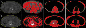 Demonstration of SMI measurements of the sarcopenic patient (A) and the non-sarcopenic patient (B).