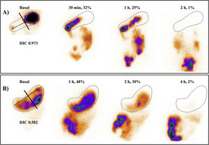 Scintigraphic evaluation of accommodation in the basal image as well as gastric emptying. A. Study of a 14-year-old girl with a definitive diagnosis of functional dyspepsia. Both the qualitative and the quantitative evaluation were compatible with fundic accommodation within normality. Gastric emptying showed values compatible with rapid emptying. B. Study of a 12-year-old boy diagnosed with food intolerance, with a scintigraphic result of altered accommodation and normal emptying. Only the images acquired in anterior projection at different hours, the IFD value and the percentage of retention are shown.