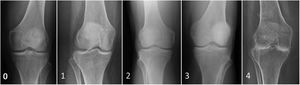 Grade of osteodegenerative changes according to the Kellgren-Lawrence scle: 0 absent, 1 doubtful, 2 mild, 3 moderate, 4 advanced.