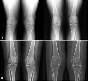 A. Patient with radiological stability with Kellgren-Lawrence grade 1 at two years of evolution. The image of the left was obtained prior to radiosynovectomy while the image on the right is from after the intervention. B. Patient with radiological progression with Kellgren-Lawrence grade 1 (image on the left is prior to radiosynovectomy) to 4 (image of the right after radiosynovectomy) at two years of evolution.