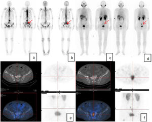 A 77-year-old man was diagnosed with PCa 1 year ago, with PSA:3903 ng/mL, ALP: 203U/L; Whole-body bone imaging suggested multiple bone metastases (a). Bone imaging after 1 year of endocrine therapy showed a slight decrease in radiation uptake (b); PSA:15.73 ng/mL, ALP:81U/L;99mTc-PSMA imaging was performed (c, e), which showed that bone destruction was seen in many parts of the bones, and some PSMA uptake was slightly increased, considering that tumor activity was still present in some lesions after bone metastasis treatment. After six months of re-treatment, the re-examination of PSA:47.30 ng/mL, ALP:107U/L, 99mTc-PSMA imaging (d, f) indicated that the tumor activity of some lesions after bone metastasis treatment was still present, and the concentration degree was increased compared with that before treatment (shown by the red arrow at the same site).