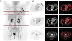 (A) MIP image (maximum intensity projection) showing a significant decrease in the size of the large hyperenhancement located in the left breast. Slightly intense hypermetabolic foci in the right axilla, attributable to lymphadenopathies of probable tumour aetiology. (B) PET, CT and PET/CT fusion images in axial plane and mediastinal window, showing a marked decrease in the size and metabolism of the lesion in the left breast (38 × 24 x 38 mm (APxTxCC)), as well as the pectoral infiltration and the ipsilateral axillary lymph nodes.