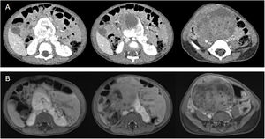 Abdomino-pelvic contrast enhanced CT (A) and T2 weighted abdomino-pelvic MRI (B) at 2 years of age. Abdominal axial sections, where there is a SK arising from the isthmus of the HK, with a large heterogeneous solid that occupies most of the lower abdomen and pelvis, with blood vessels running through it.