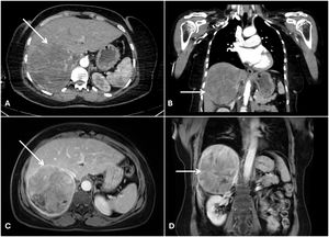 Thorax CT detected a large heterogeneous mass in the right upper quadrant (arrow) (Fig. 1A and B). Abdominal MRI showed a heterogeneous signal mass lesion measuring approximately 11 × 11 × 12 cm in the largest dimensions, with cystic-necrotic areas in the central section, capsule contrast enhancement in the late phase (arrow) (Fig. 1C and D).