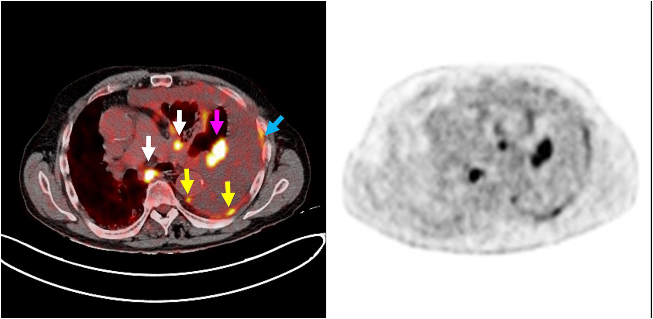 Association of PET/CT and VATS findings with histology analysis in the ...