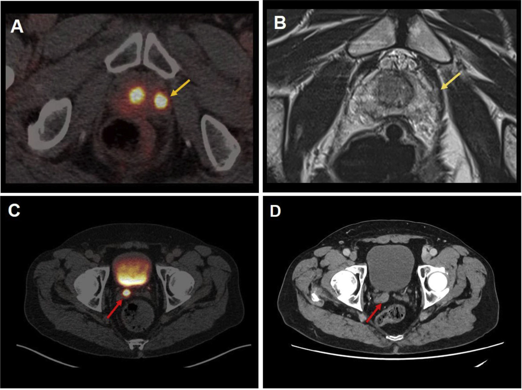 Comparison of staging using [68Ga]Ga-PSMA-11 PET/CT and ...