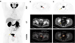 (A) Maximum intensity projection in a patient with high-risk prostate cancer, with primary lesion in the left prostatic lobe (red arrow) and locoregional lymph node involvement (yellow arrow), without distant metastasis. (B) Example of automatic segmentation for calculating the SUVmax in the prostatic tumor (red arrow). (C) Foci of pathological lymph node uptake in the right internal iliac region (yellow arrow, Score = 2; reader confidence = 5).