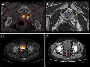 Example of extracapsular extension and invasion of the seminal vesicles in two patients with prostate cancer. Extracapsular extension is visible in the fusion PSMA-PET/CT images (A: yellow arrows) and in the magnetic resonance study (B, yellow arrows). (C) Axial images of fusion PSMA-PET/CT images in which a pathological deposit is identified in the right seminal vesicle with morphological correlation in the CT image (D, red arrows).