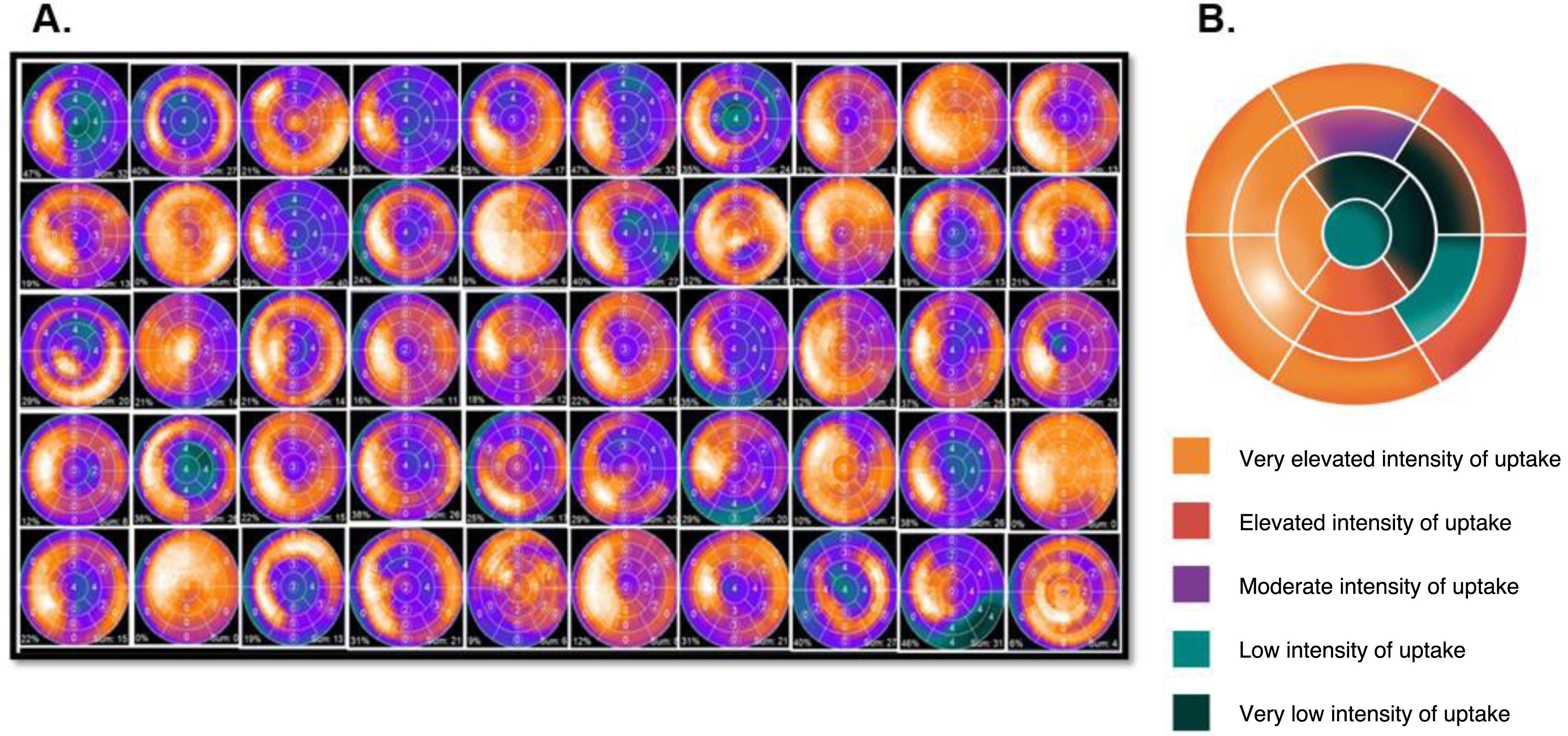 Role of [99mTc]Tc-DPD gated-SPECT-CT in the assessment of myocardial ...