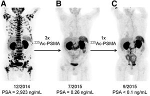 [68Ga]Ga-PSMA-11 PET/CT of a patient treated with 4 cycles of [225Ac][Ac(PSMA-617)]. (A) Pre-therapeutic study. (B) Re-staging at two months of the 3rd cycle of [225Ac][Ac(PSMA-617)]. (C) Re-staging after two months of the 4th cycle. Image originally published in The Journal of Nuclear Medicine: C. Kratochwil et al., “225 Ac-PSMA-617 for PSMA-Targeted α-Radiation Therapy of Metastatic Castration-Resistant Prostate Cancer,” J. Nucl. Med., vol. 57, no. 12, pp. 1941–1944, Dec. 2016. © SNMMI.41