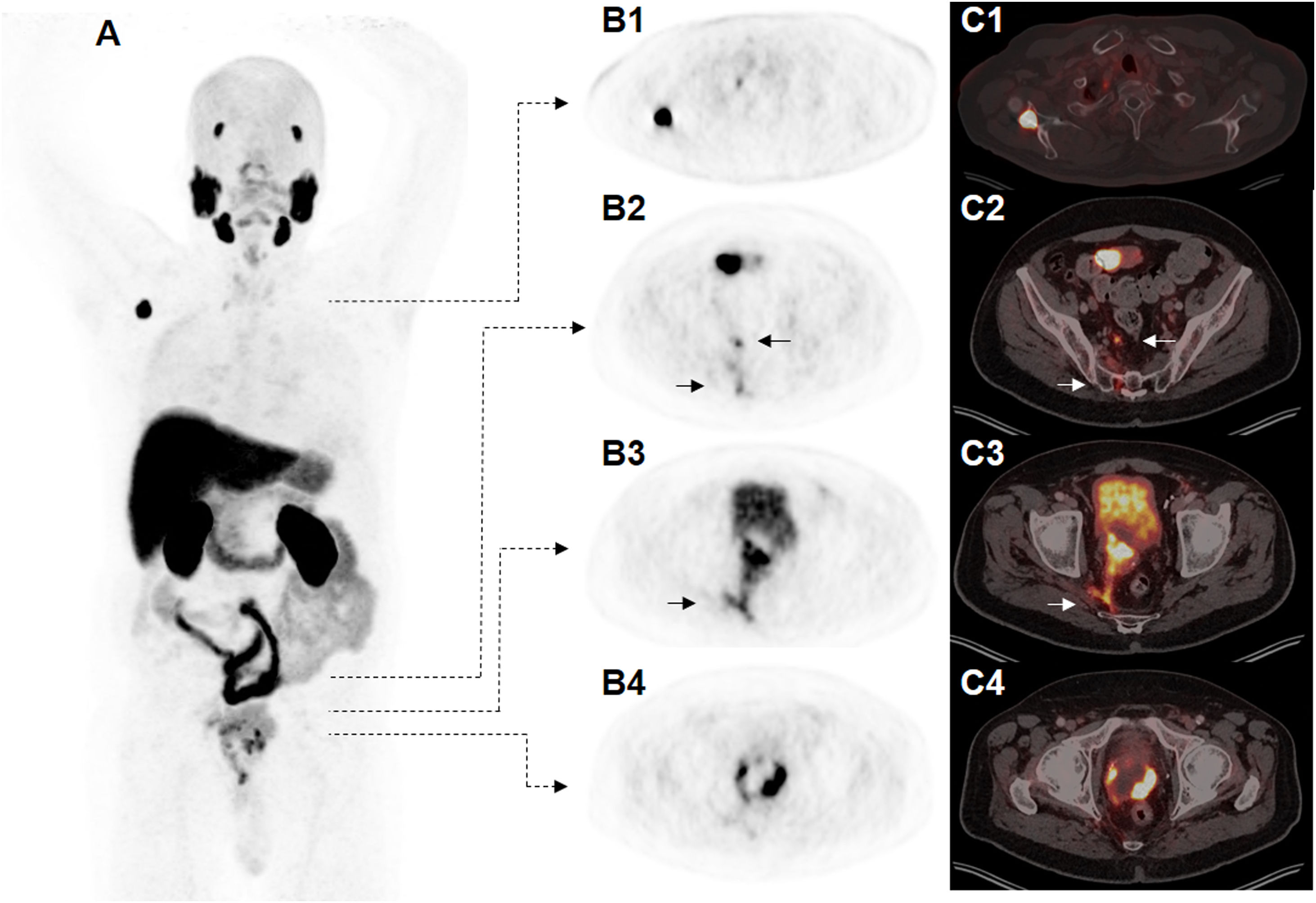 The synergic effect of Multiparametric MRI and [18F]PSMA-1007 PET/CT ...