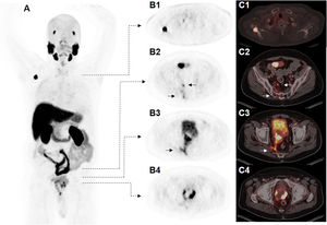 [18F]PSMA-1007 PET/CT scan; Maximum intensity Projection (MIP) (A), PET imaging (B1 −  4), fused [18F]PSMA-1007 PET/CT images (C1 − 4). Solitary metastasis of the right scapular bone (B1 and C1). Lymph node metastases and infiltration of the sacral foramina (B2 + C2) and the right piriformis muscle (B3 + C3). Intraprostatic PSMA uptake and central hypodense extension after multiple transurethral resections (B4 + C4).