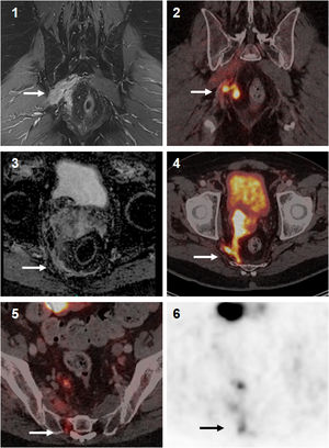 Synergistic effect of multiparametric MRI and [18F]PSMA-1007 PET/CT imaging: Better delineation and discrimination of the local tumor extent (1,2). Due to the lack of ADC descent on MRI (3), it is not possible to distinguish reliably between infiltration or possible oedema. PSMA PET/CT (4) suggests tumor infiltration due to PSMA expression. In addition, [18F]PSMA-1007 imaging (5, 6) indicates tumor infiltration of the sacral plexus, which escapes the detection by the standard MRI protocol.