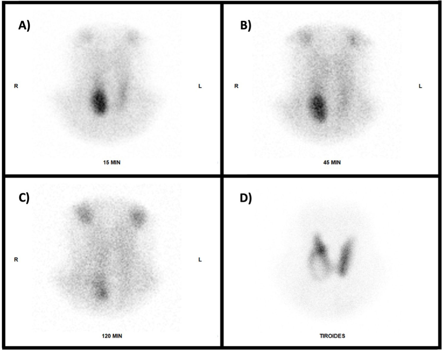 Incidental detection of thyroid carcinoma and parathyroid adenoma with ...