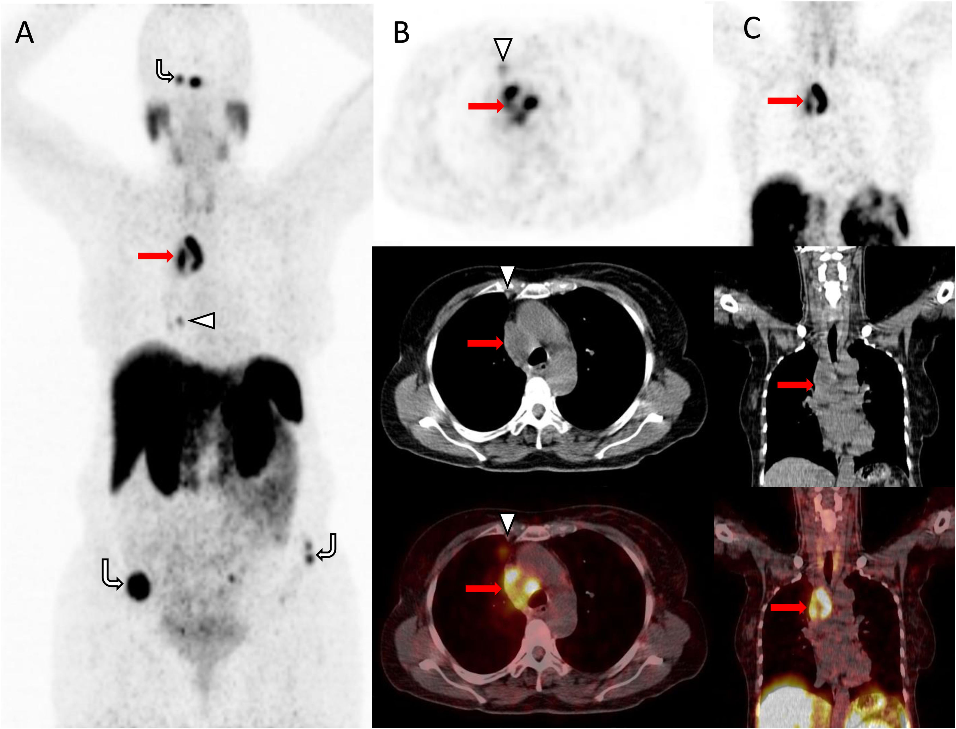 Superior vena cava syndrome as a manifestation of primary atypical ...