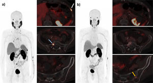 78-year-old male with mCRPC that has progressed to ARPI (abiraterone) and taxane (docetaxel) with poor tolerance. PSA 26.05 ng/mL. PSMA-PET was performed to evaluate the patient as a possible candidate for [177Lu]Lu-PSMA-617 (a), showing disseminated blastic metastatic bone disease, with lesions in the seventh left anterolateral costal arch with SUVmax 29.23; PSMA-RADS 5 (white arrow) in the right sacral/iliac crest with SUVmax of 32.12; PSMA-RADS 5 (blue arrow). Given the PSMA-PET findings and the adequate clinical-analytical profile of the patient, treatment with [177Lu]Lu-PSMA-617 was performed. After the second cycle of treatment (at 12 weeks) a new PSMA-PET for control was carried out (b) which despite showing complete response of the known metastatic bone lesions, four new metastatic bone lesions were observed with a SUVmax of up to 6.12 in one left iliac lesion (orange arrow), suggesting disease progression. The PSA levels at this time are 37.38 ng/mL. Due to the analytical and radiological progression, it was decided to suspend the treatment.