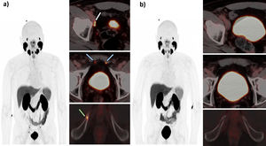 60-year-old male with prostate adenocarcinoma Gleason 7 (3 + 4). Pretreatment PSA 7 ng/mL. Underwent radical prostatectomy and lymph node dissection. pT3aR1 pN0 cM0. Thereafter, salvage radiotherapy was performed in the prostatic bed due to biochemical recurrence (PSA 0.35 ng/mL). For biochemical progression (PSA 1.28 ng/mL), PSMA-PET was performed (a) observing pathological pelvic adenopathies with a SUVmax of 10.34 in the external right iliac chain; PSMA-RADS 4 (white arrow) and SUVmax of 12.18 located posterior to the rectal muscle of the abdomen; PSMA-RADS 4 (blue arrow) and single bone lesion in the right ischiopubic ramus with a SUVmax of 8.17; PSMA-RADS 4 (green arrow). The decision was made to perform treatment with ADT + ARPI (apalutamide). Four months after initiating therapy, a new control PSMA-PET was made (b) showing complete disease response. The PSA levels at this time are 0.04 ng/mL.