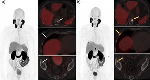 75-year-old male with prostate adenocarcinoma Gleason 9 (5 + 4). cT2 cN0-1 cM0. Pretreatment PSA 4 ng/mL. The patient was treated with prostatic radiotherapy and of the pelvic lymph node chains + ADT for 3 years. Due to biochemical progression (PSA 0.7 ng/mL; PSA doubling time of 5 meses), PSMA-PET was performed (a) observing three blastic bone lesions (white arrows) in the fifth right anterior costal arch (SUVmax of 9.03), vertebral body of D11 (SUVmax of 27.87) and right iliac (SUVmax of 8.32), compatible with bone metastases (PSMA-RADS 5). Given the PSMA-PET findings, oligometastatic CRPC was considered and the decision was made to treat these bone lesions with SBRT. Three months after the treatment with SBRT, a new control PSMA-PET was performed (b) observing progression of the lesions (orange arrows), in both size and uptake, in the fifth right anterior costal arch (SUVmax of 21.84), D11 (SUVmax of 46.86) and right iliac (SUVmax of 23.04). According to RECIP criteria, increase in total tumoral volume of 110% (> 20%). The PSA levels at this time were 1.21 ng/mL. The patient has currently started a new line with (abiraterone), with descent in PSA (PSA 0.09 ng/mL).