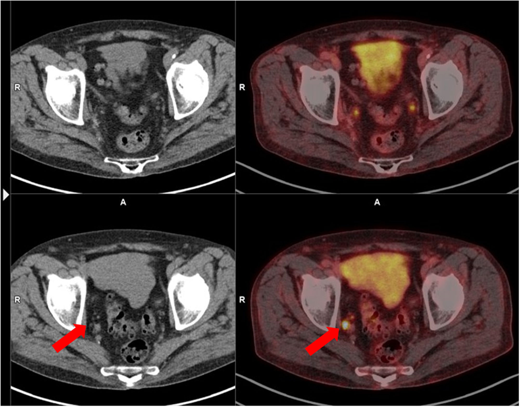 PSMA PET/CT quick procedure guide | Revista Española de Medicina ...