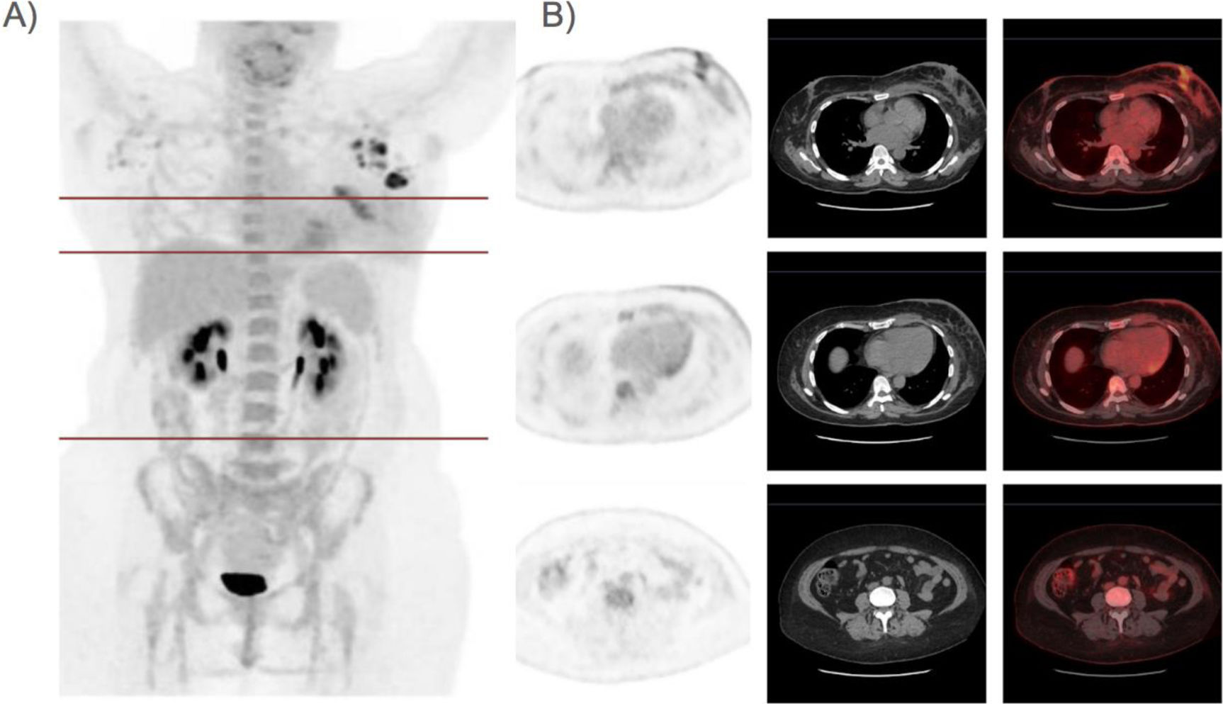 Role of [18F]FDG PET/CT in the evaluation of inflammatory breast cancer ...