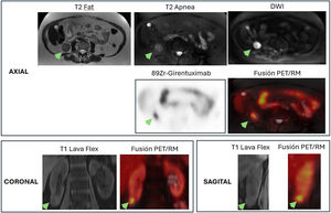 72-year-old female; Clear Cell RCC. Axial slices: T2 Fat, T2 Breath-hold, DWI, 89Zr-Girentuximab, PET/MRI Fusion Coronal slices: T1 Lava Flex, PET/MRI Fusion Sagittal slices: T1 Lava Flex, PET/MRI Fusion A 72-year-old female patient with a solid cortical mass in the lower pole of the right kidney, under follow-up since 2024. PET/MRI performed 5 days after administration of 1.12 mCi of ⁸⁹Zr-girentuximab shows a partially exophytic 28 mm lesion, heterogeneous and with marked diffusion restriction (ADC < 1), presenting significant tracer uptake (SUVmax 10.5), highly suggestive of clear cell RCC.