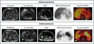 70-year-old male; Bilateral Oncocytomas. Left kidney, axial slices: T2 Breath-hold, T1 Lava Flex, DWI, 89Zr-Girentuximab, PET/MRI Fusion Right kidney, axial slices: T2 Breath-hold, T1 Lava Flex, DWI, 89Zr-Girentuximab, PET/MRI Fusion A 70-year-old male patient with a history of right partial nephrectomy for oncocytoma in 2022. PET/MRI performed 5 days after administration of 1.078 mCi of ⁸⁹Zr-girentuximab shows two solid renal lesions without tracer uptake: a posterior exophytic lesion in the lower pole of the right kidney (29 mm) and another cortical lesion in the mid-third of the left kidney with a central scar (33 mm), both without diffusion restriction and morphologically compatible with oncocytoma. Postsurgical changes show no radiopharmaceutical deposits.