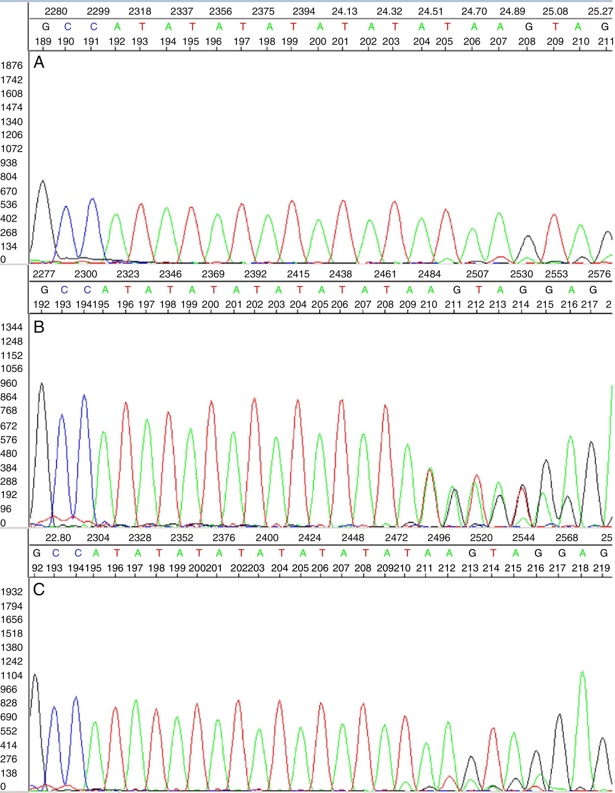 Genetic susceptibility to Gilbert's syndrome in a Valencian population ...