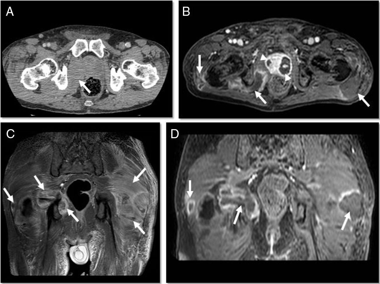 Pyomyositis Rad Pyomyositis secondary to prostatic abscesses | Revista Clínica Española