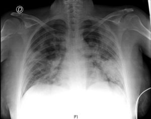Chest X-ray upon hospital admission.