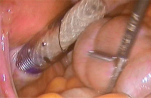 Entrada de la prótesis por el canal vaginal protegido con trocar enfundado.