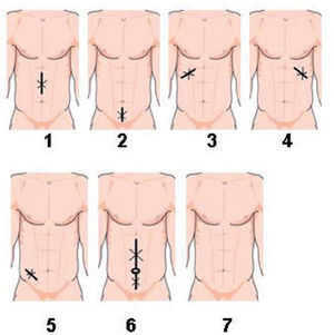 Ideogramas de los diferentes tipos de hernia incisional.