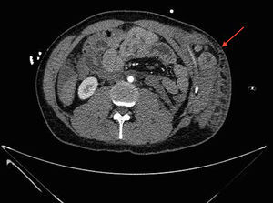TC abdominal (corte axial). Herniación de asas de intestino delgado que protruyen hasta el 11.° espacio intercostal. Hemoperitoneo.