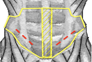 Esquema del procedimiento quirúrgico. Las líneas discontinuas representan la plicatura musculoaponeurótica, mientras que las líneas continuas, las MPP. Notese cómo en la línea alba ambas mallas se sobreponen (zona achurada). La sutura corrida de las mallas se anclaron hacia cefálico en el reborde subcostal, por caudal en el ligamento inguinal, por media lateral a la línea alba y por lateral en ambos flancos.