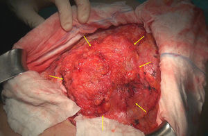 Hernia incisional cubierta con un tejido multiperforado de mala calidad e insuficiente para garantizar una función de prensa abdominal adecuada.